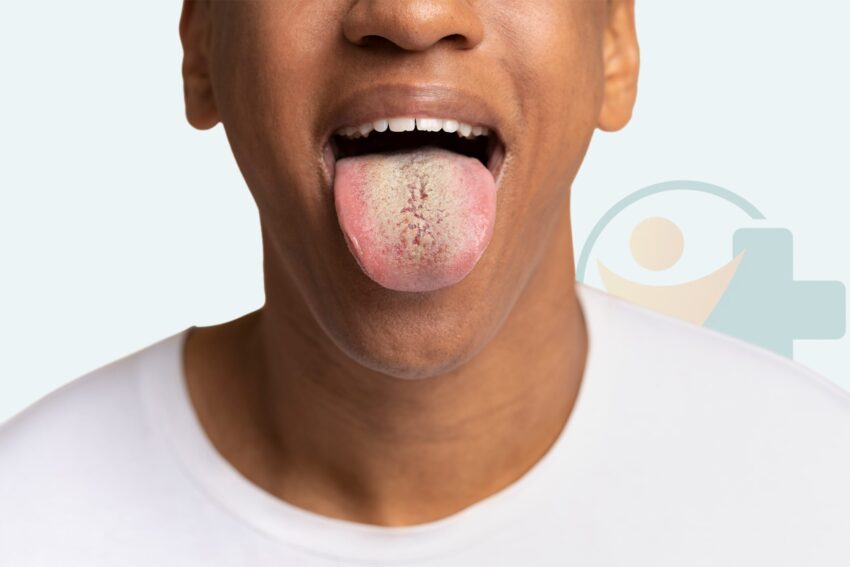 Image for Candida (svampeinfektion) treatment