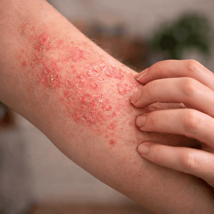 Eczema-medicin og smarte hudplejevalg