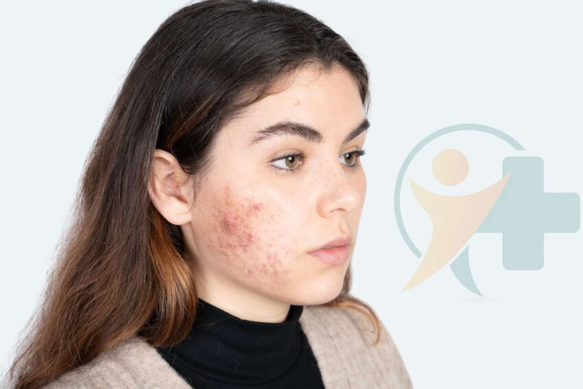 Image for Akne treatment