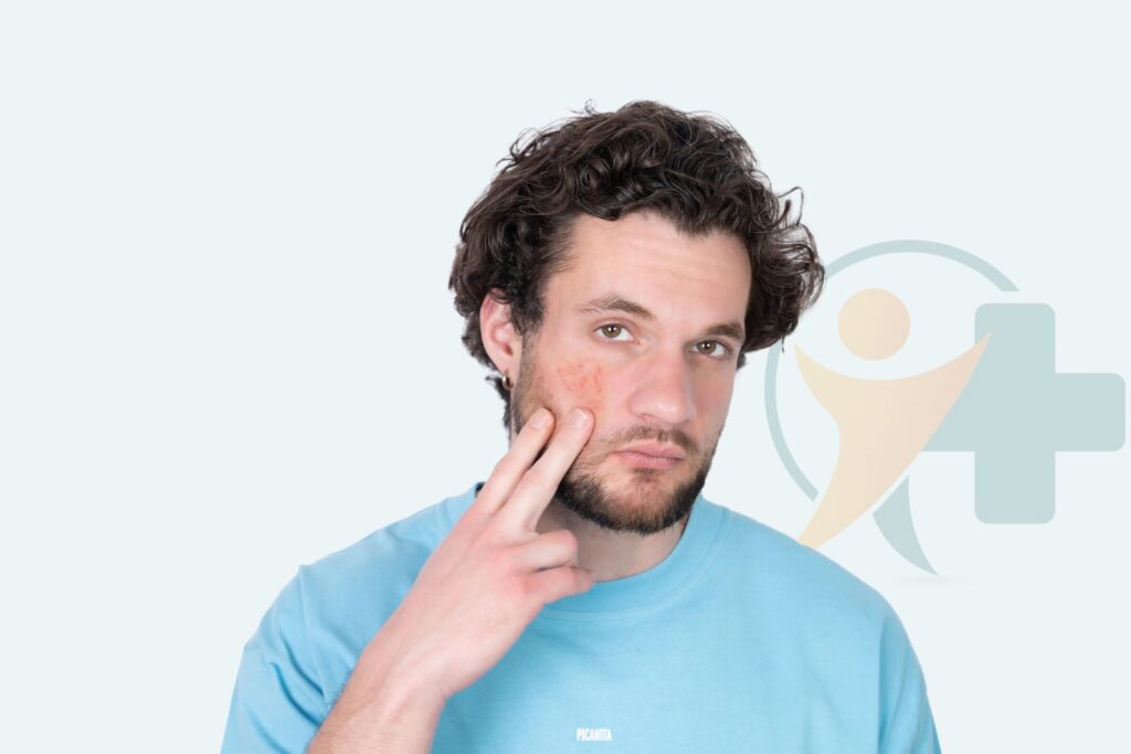 Featured image for Rosácea treatment