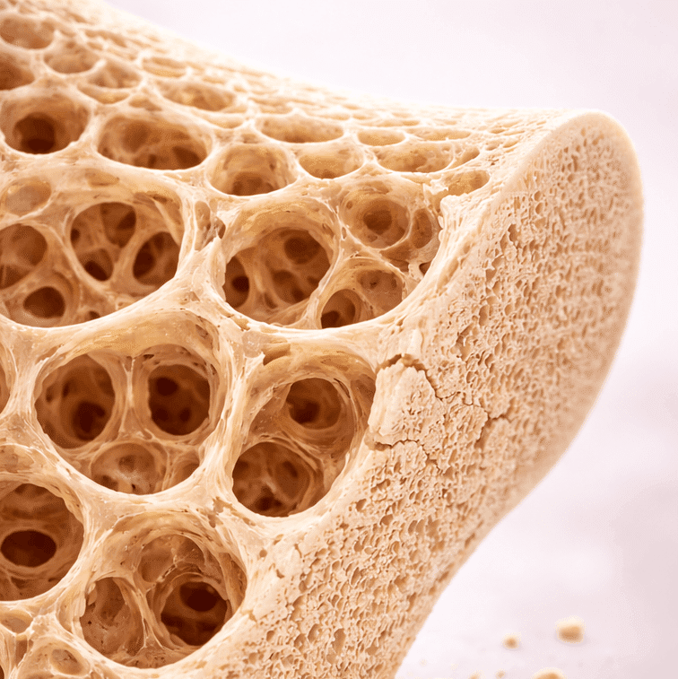Osteopenie is een fase waarin de botdichtheid lager is dan normaal, maar nog niet laag genoeg om als osteoporose te worden geclassificeerd.