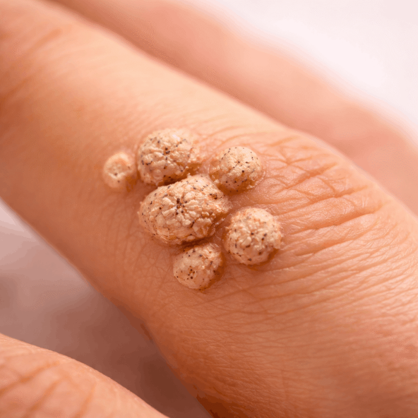 Warts are caused by infection with the human papillomavirus (HPV).