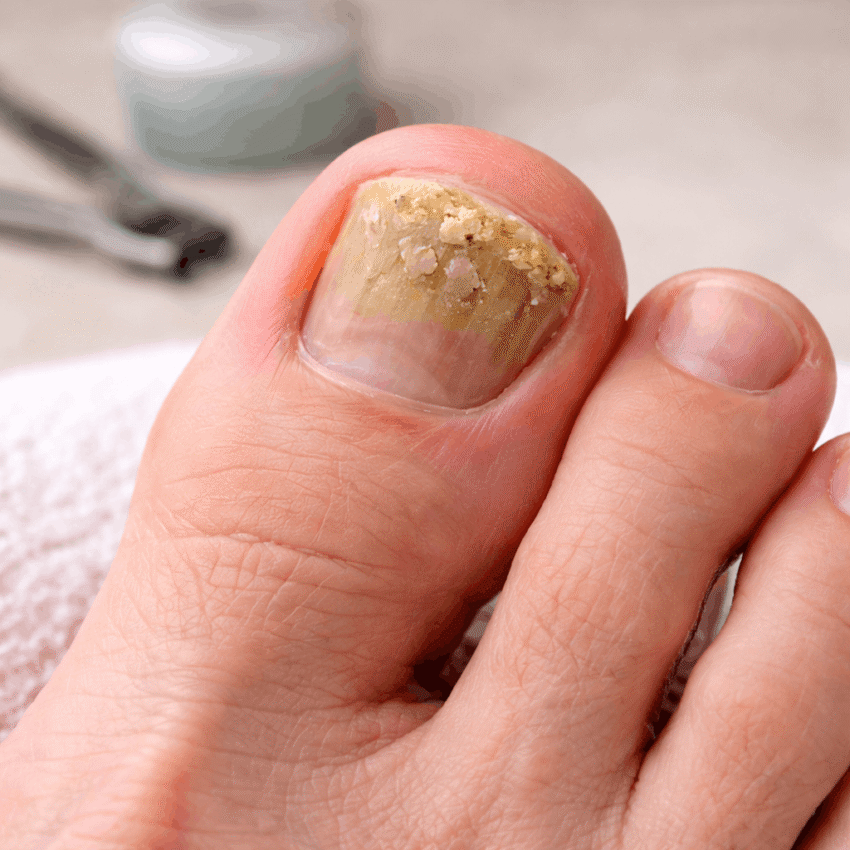 Which symptom is most commonly linked to athlete’s foot rather than toenail fungus?