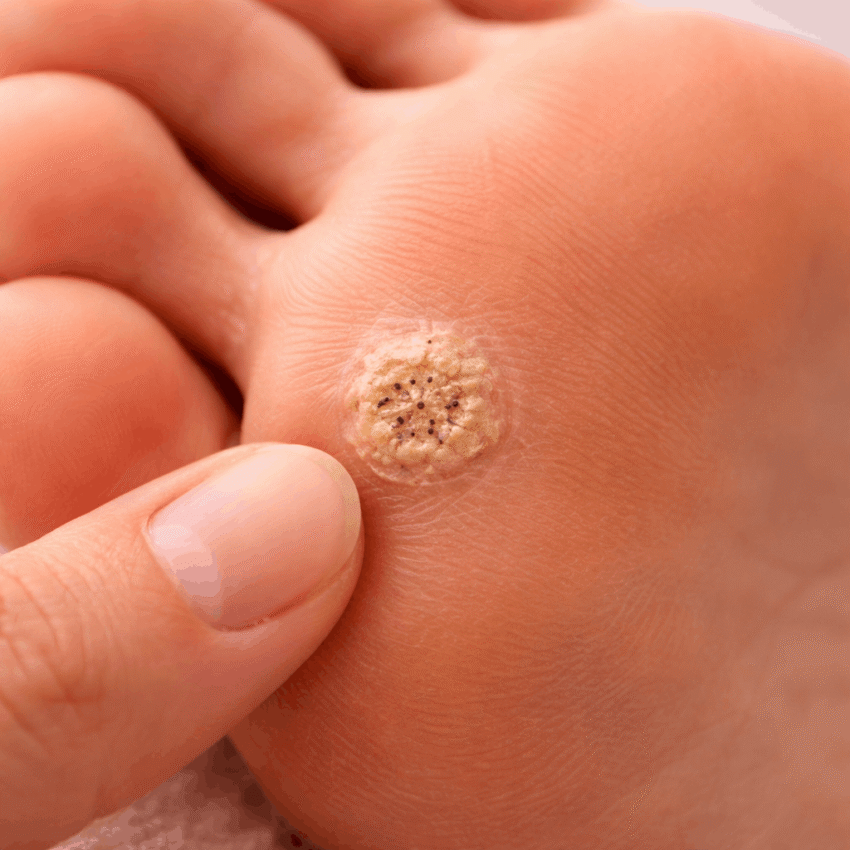 Which type of wart commonly appears on the bottom of the feet and can make walking painful?