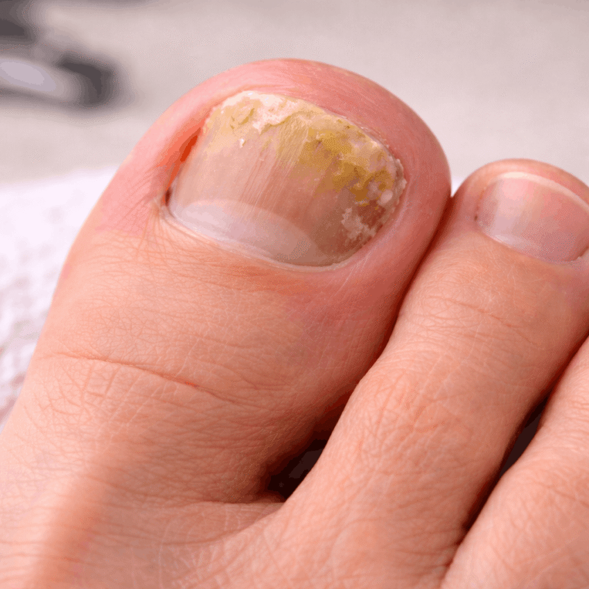 Toenail fungus often develops slowly and may not cause pain in the early stages.