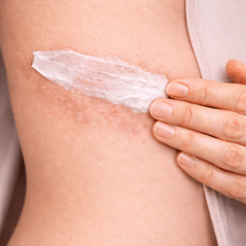 Keeping the shingles rash clean, dry, and covered can help reduce the risk of spreading the virus.