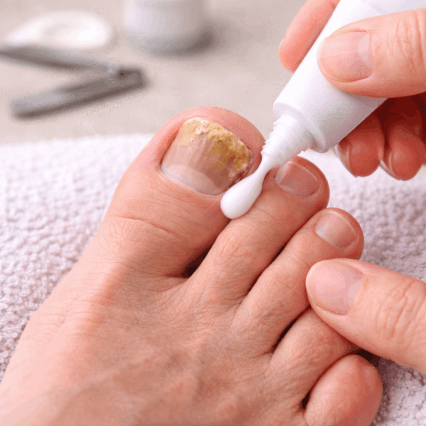 Topical antifungal creams usually require long-term, consistent use to be effective.