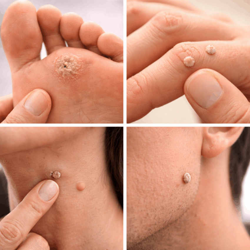 Warts can spread from one part of your body to another if they are picked or touched.