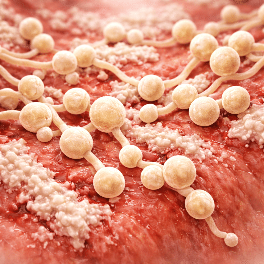 Which of the following best describes Candida overgrowth?