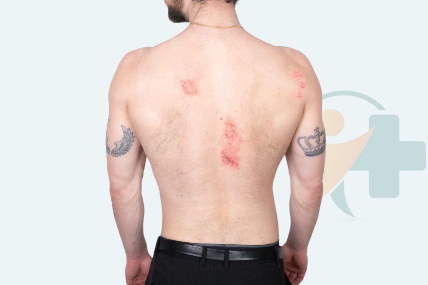 Featured image for Shingles treatment