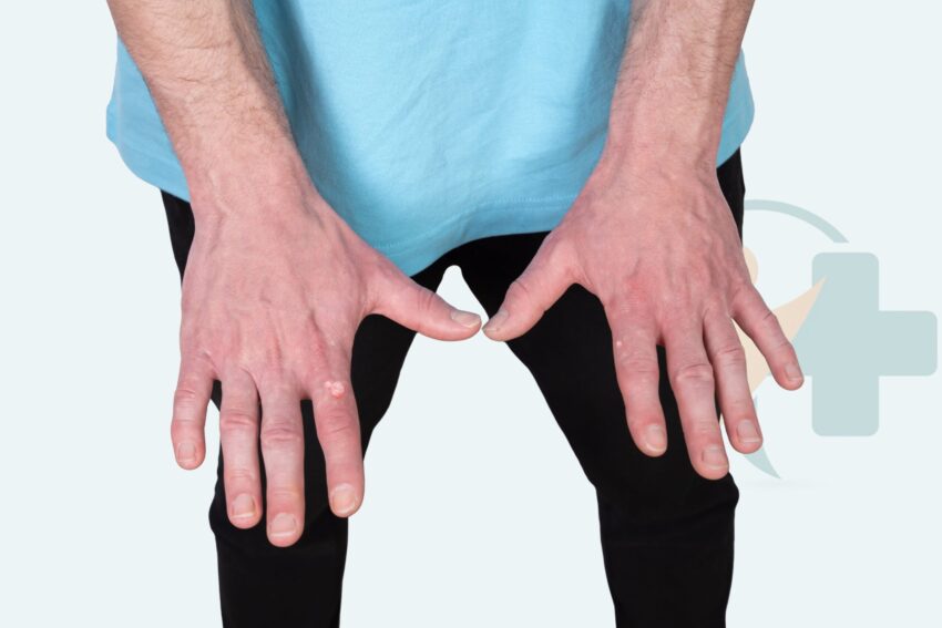 Warts on hands – common skin growths caused by HPV | Transtoyou